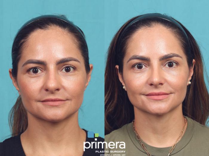 Before & After Rhinoplasty Case 1035 Front View in Orlando, Winter Park & Tampa, Florida