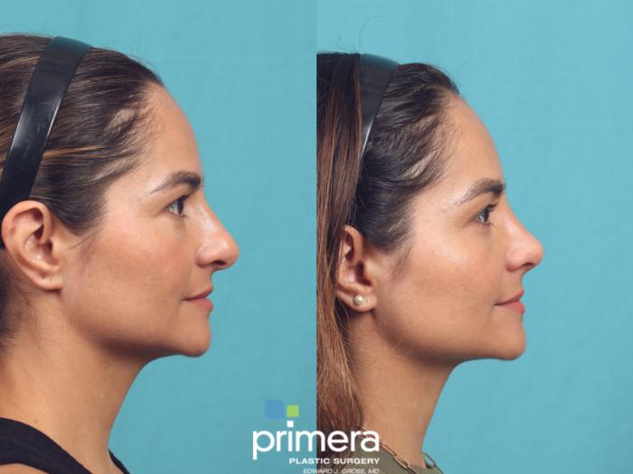 Before & After Rhinoplasty Case 1035 Right Side View in Orlando, Winter Park & Tampa, Florida