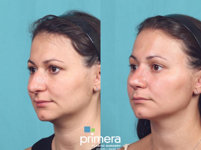 Before & After Rhinoplasty Case 1037 Left Oblique View in Orlando, Winter Park & Tampa, Florida