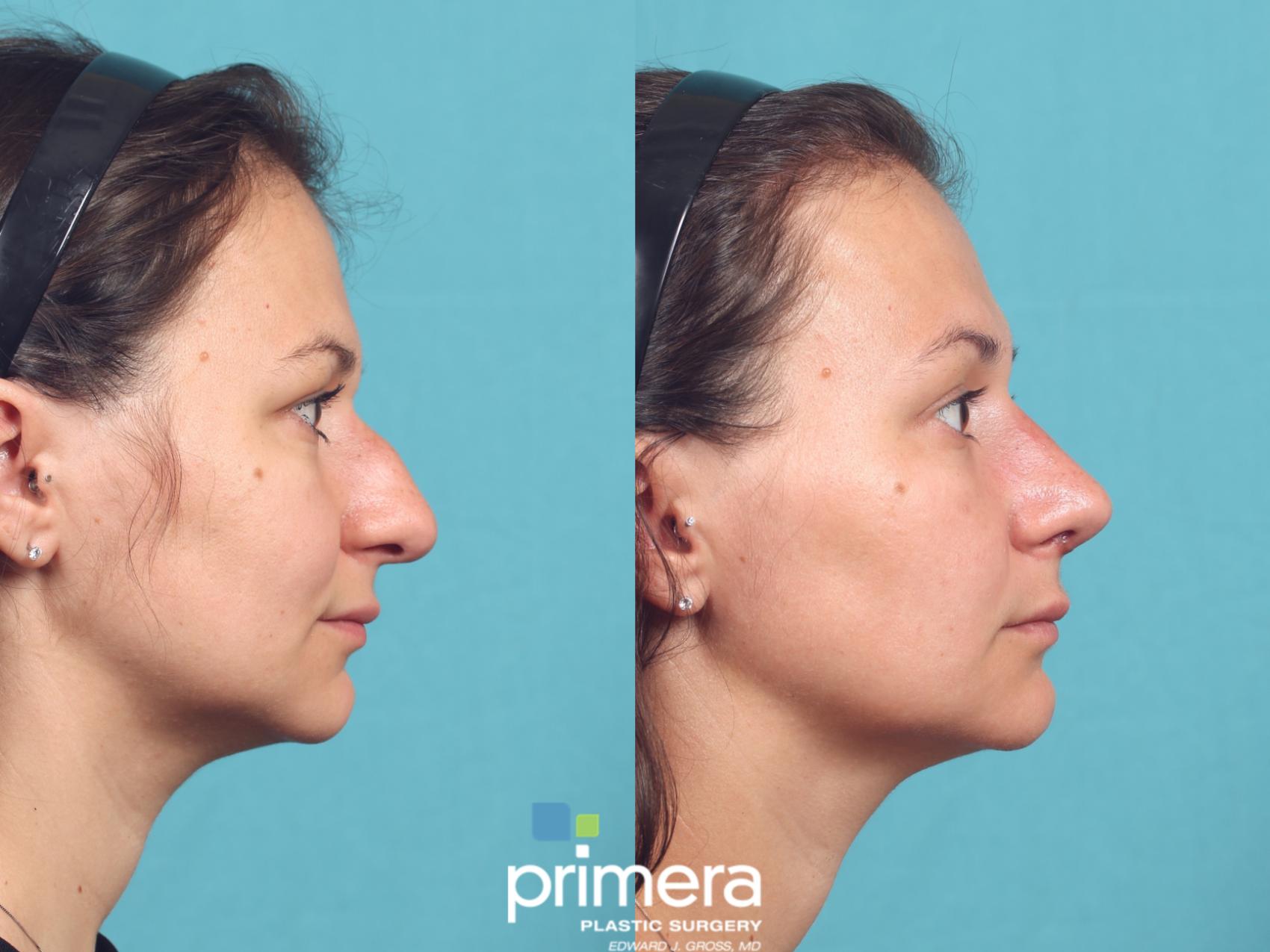 Before & After Rhinoplasty Case 1037 Right Side View in Orlando, Winter Park & Tampa, Florida