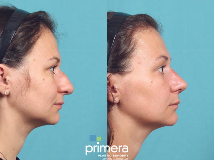 Before & After Rhinoplasty Case 1037 Right Side View in Orlando, Winter Park & Tampa, Florida