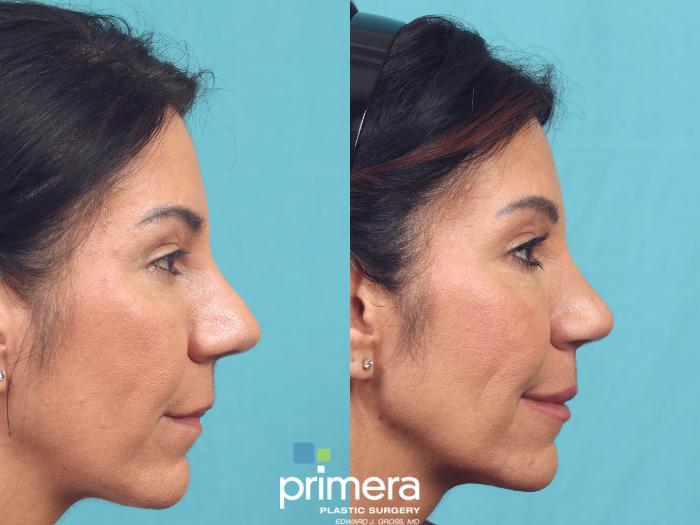 Before & After Rhinoplasty Case 1040 Left Side View in Orlando, Winter Park & Tampa, Florida