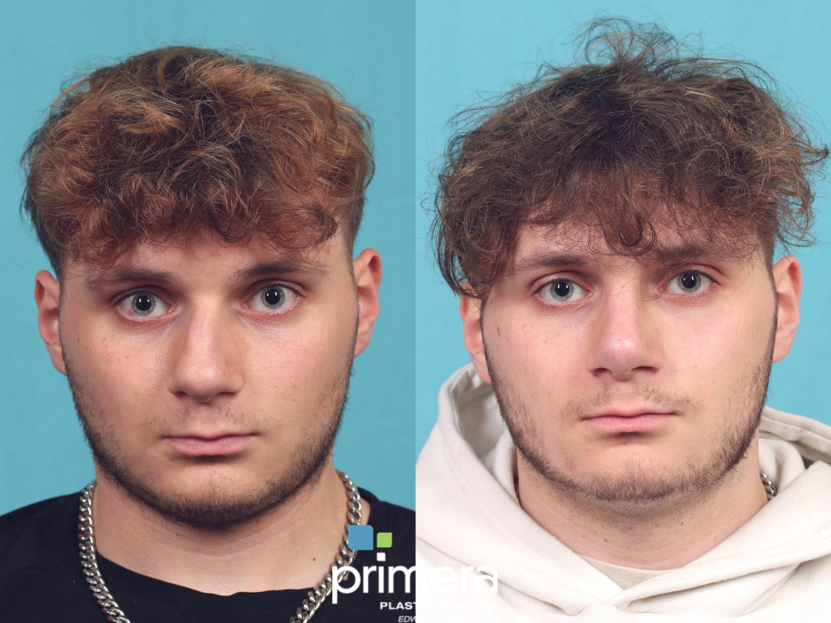 Before & After Rhinoplasty Case 1042 Front View in Orlando, Winter Park & Tampa, Florida