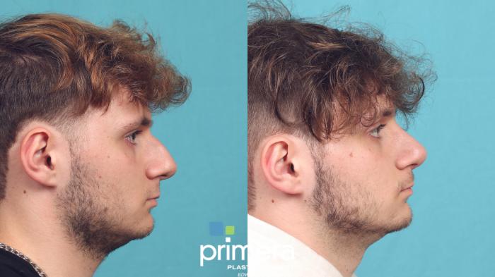 Before & After Rhinoplasty Case 1042 Right Side View in Orlando, Winter Park & Tampa, Florida