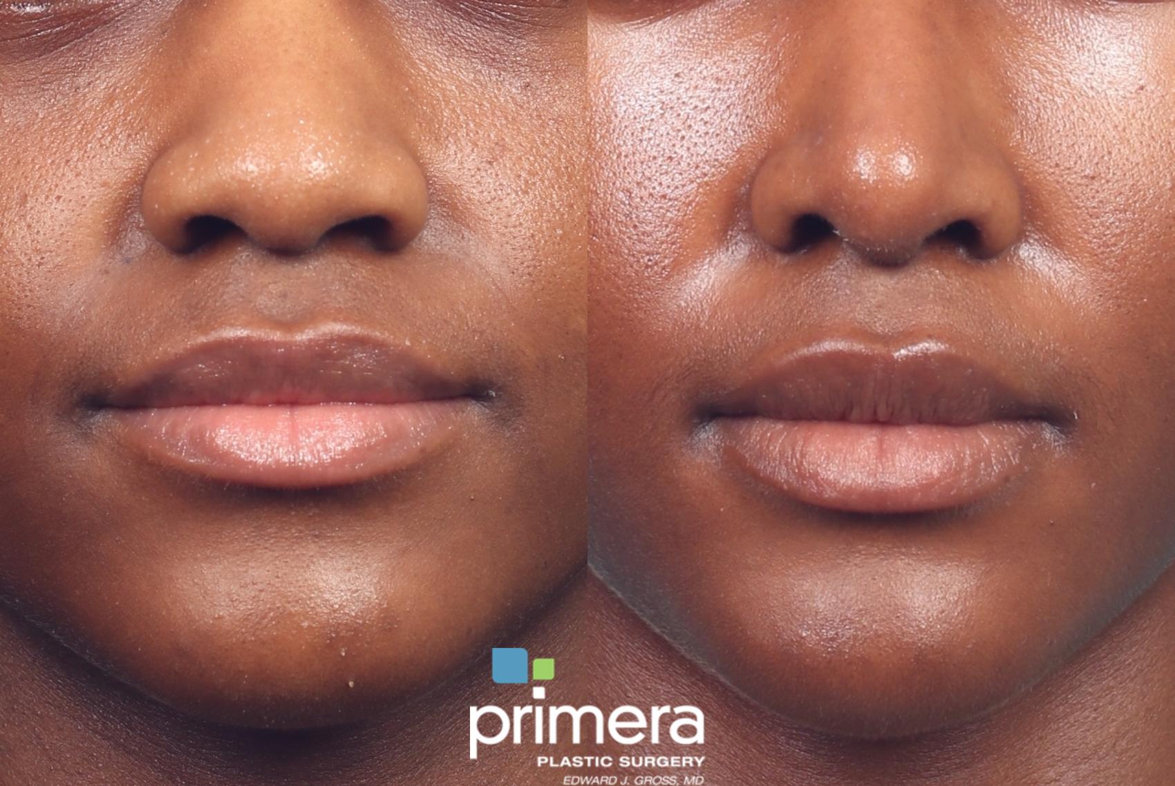 Before & After Rhinoplasty Case 1046 Front View in Orlando, Winter Park & Tampa, Florida