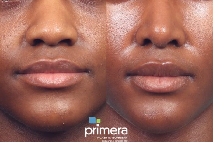 Before & After Rhinoplasty Case 1046 Front View in Orlando, Winter Park & Tampa, Florida