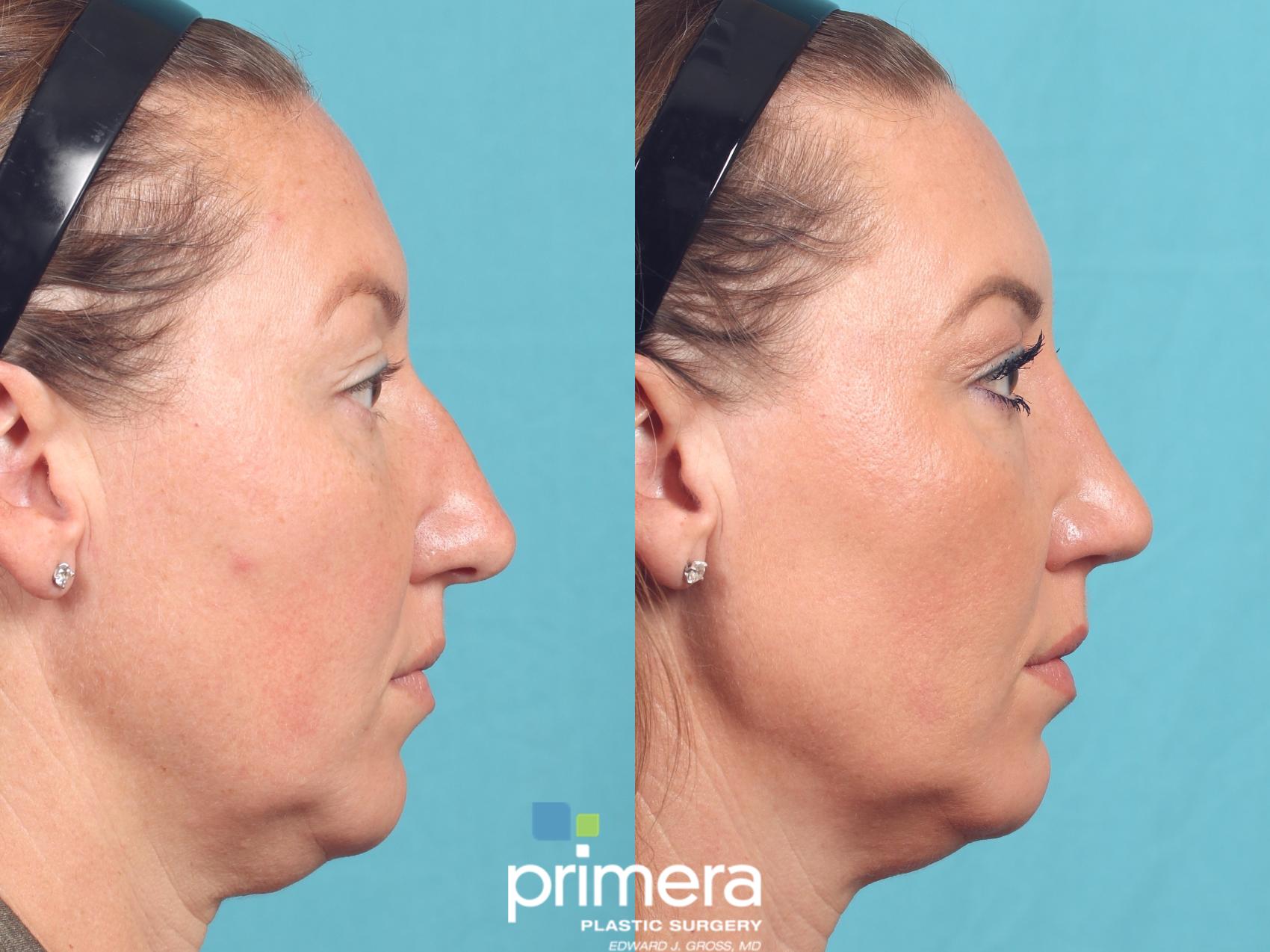 Before & After Rhinoplasty Case 1050 Right Side View in Orlando, Winter Park & Tampa, Florida