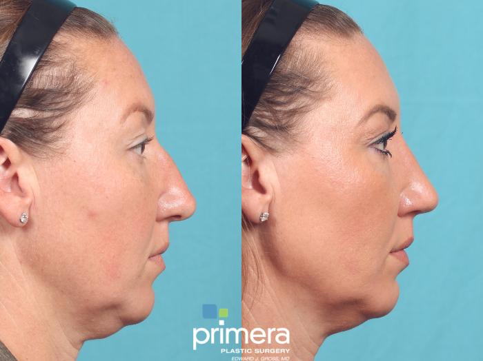 Before & After Rhinoplasty Case 1050 Right Side View in Orlando, Winter Park & Tampa, Florida