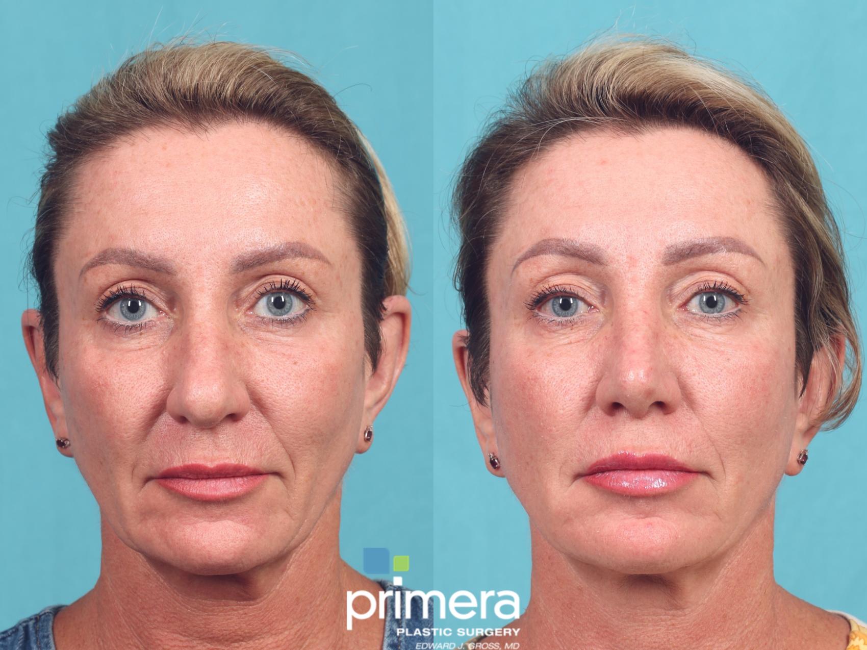 Before & After Rhinoplasty Case 1052 Front View in Orlando, Winter Park & Tampa, Florida