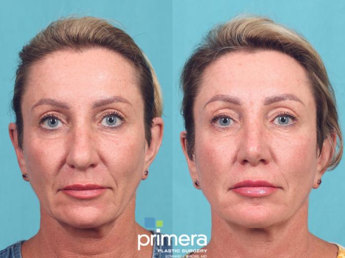 Before & After Rhinoplasty Case 1052 Front View in Orlando, Winter Park & Tampa, Florida