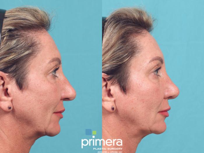 Before & After Rhinoplasty Case 1052 Right Side View in Orlando, Winter Park & Tampa, Florida