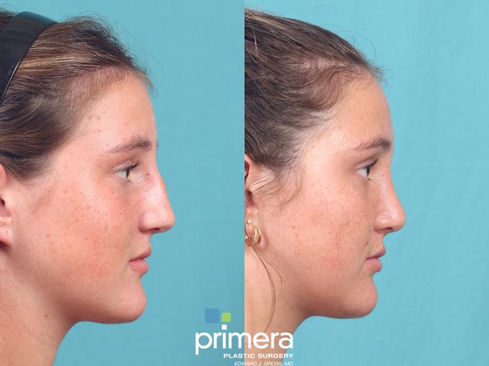 Before & After Rhinoplasty Case 1053 Right Side View in Orlando, Winter Park & Tampa, Florida