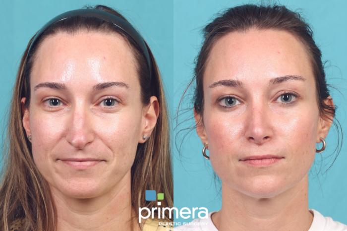 Before & After Rhinoplasty Case 1054 Front View in Orlando, Winter Park & Tampa, Florida