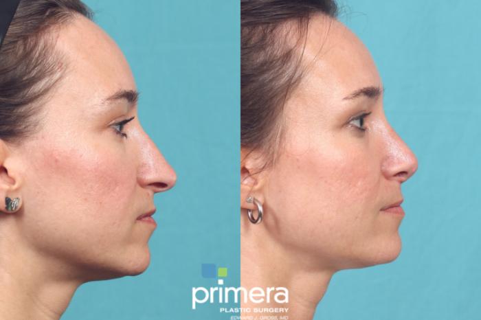 Before & After Rhinoplasty Case 1054 Right Side View in Orlando, Winter Park & Tampa, Florida