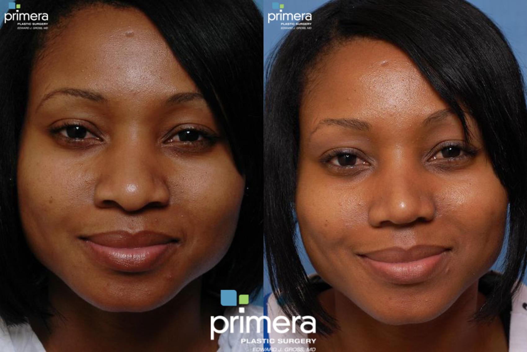 Rhinoplasty Before and After Pictures Case 11 Orlando, Florida