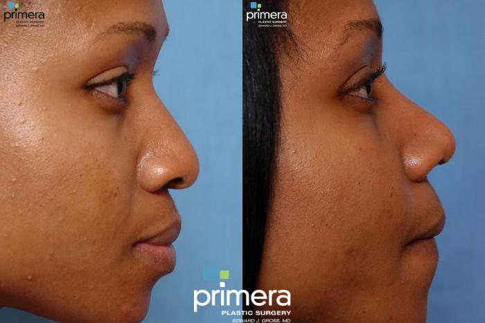 Rhinoplasty Before and After Photos