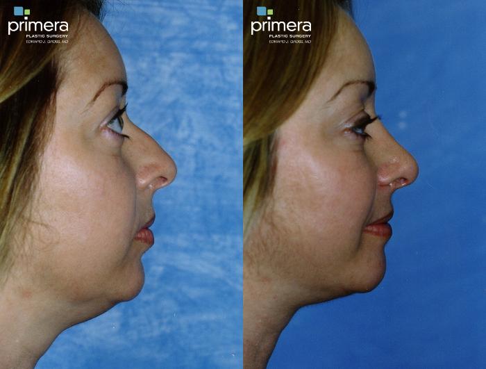 Before & After Neck & Face Liposuction Case 146 view-1 View in Orlando, Florida