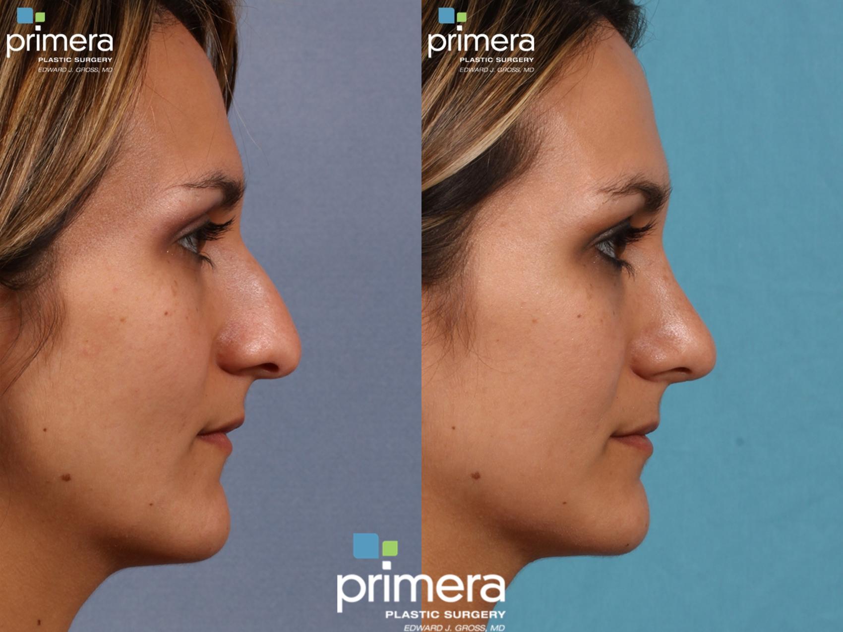 Before & After Rhinoplasty Case 175 view-1 View in Orlando, Winter Park & Tampa, Florida