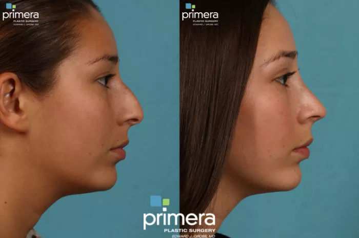 rhinoplasty-177-view1-