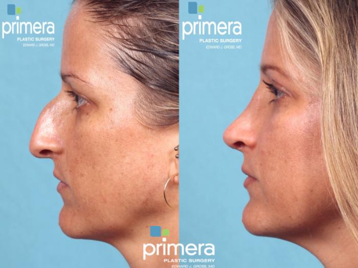 Before & After Rhinoplasty Case 201 view-1 View in Orlando, Florida