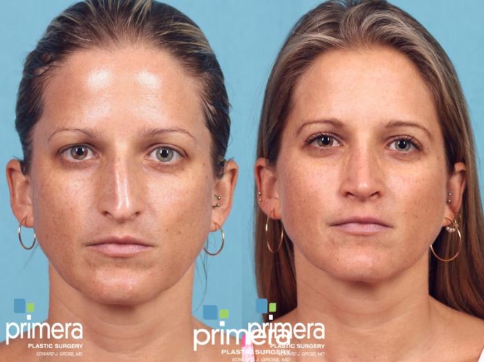 Before & After Blepharoplasty Case 201 view-2 View in Orlando, Florida