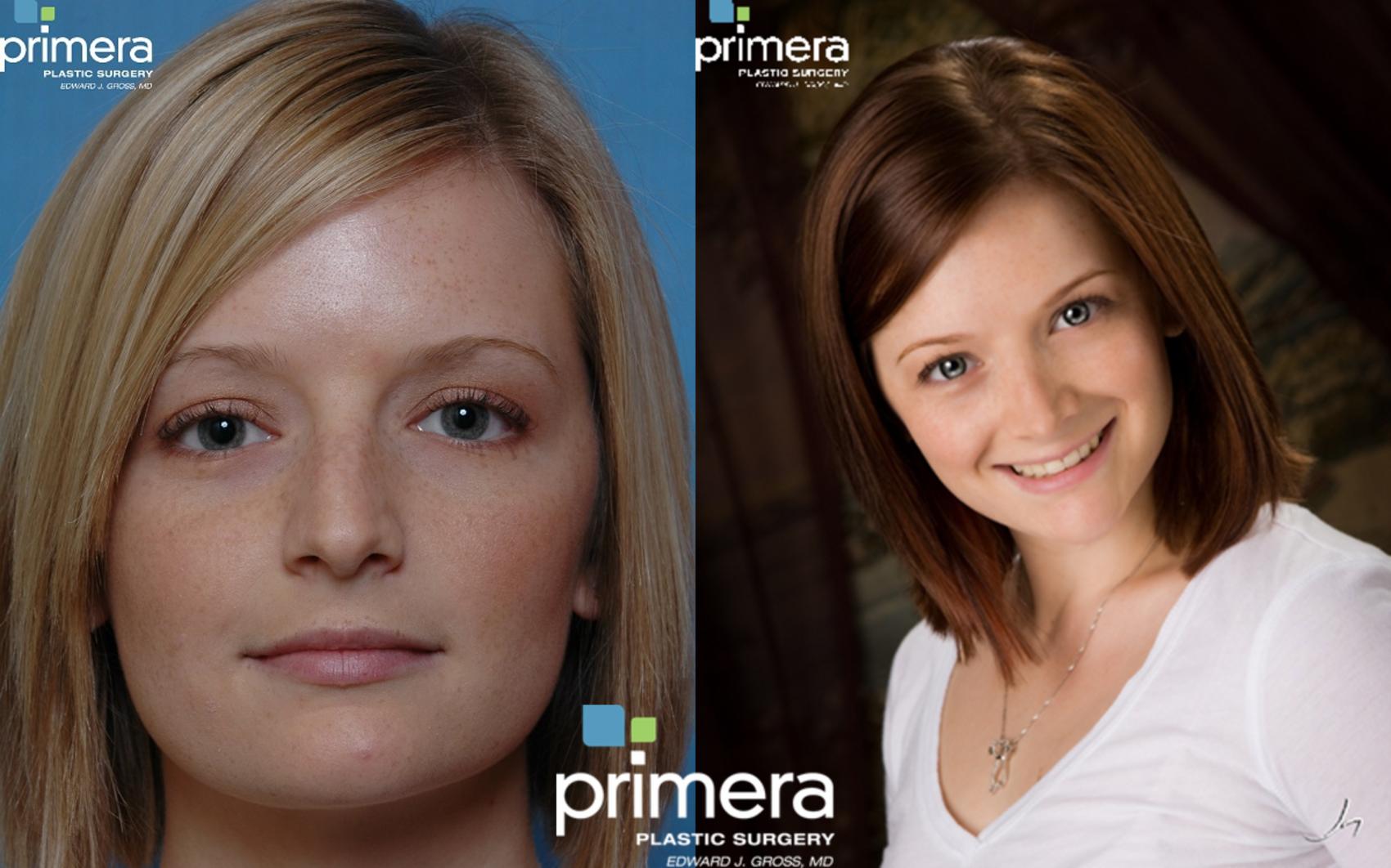 Rhinoplasty Before and After Pictures Case 22 Orlando, Florida