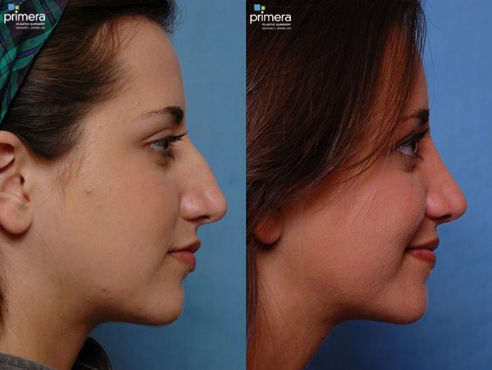 Before & After Rhinoplasty Case 23 view-2 View in Orlando, Florida