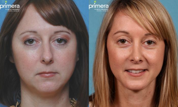 Before & After Rhinoplasty Case 230 view-1 View in Orlando, Florida