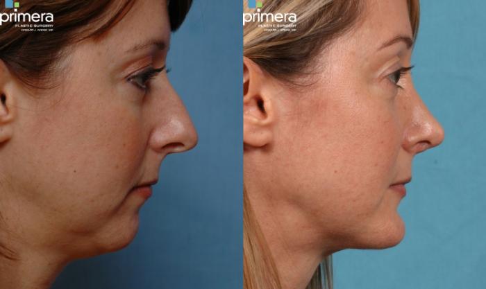 Before & After Rhinoplasty Case 230 view-2 View in Orlando, Florida