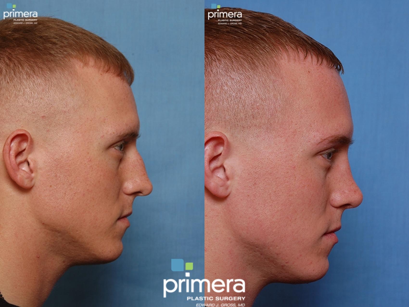 Before & After Rhinoplasty Case 28 view-1 View in Orlando, Florida