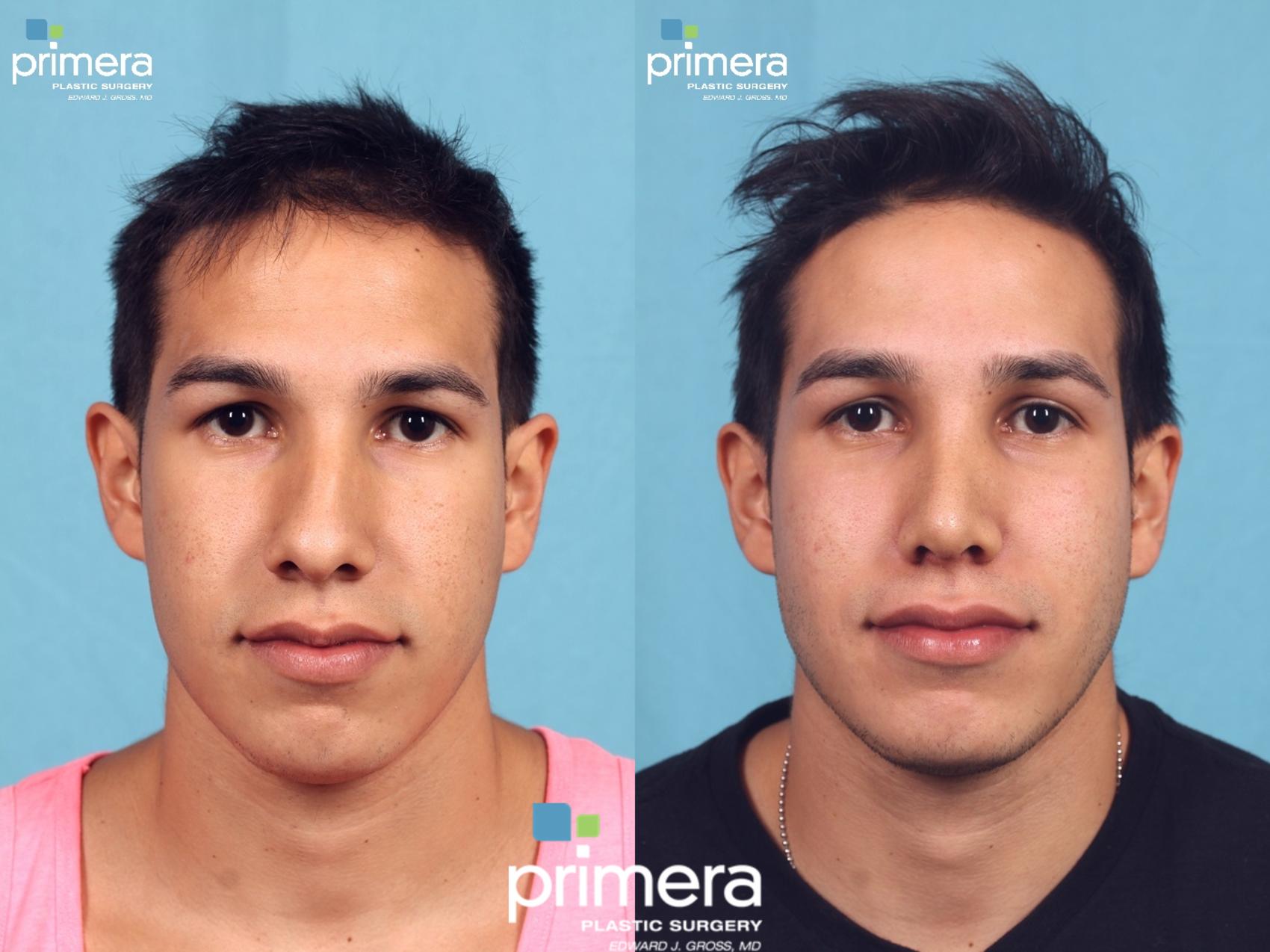 Before & After Surgery for Men Case 297 view-1 View in Orlando, Florida