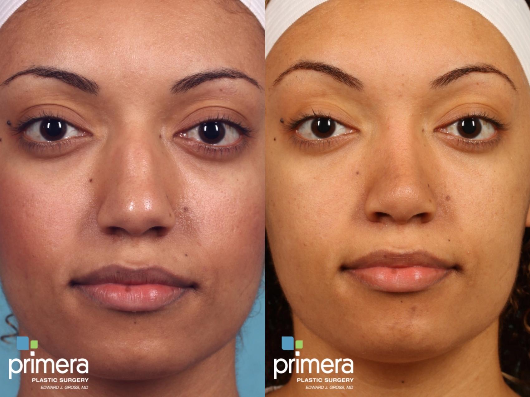 How Much Does Rhinoplasty Cost In Orlando? – Primera Plastic Surgery