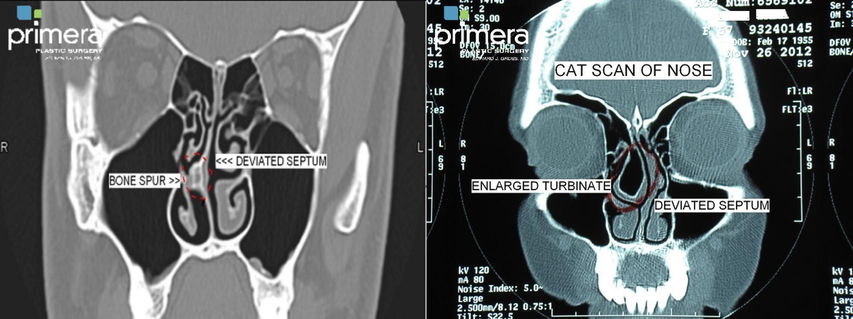 deviated septum xray