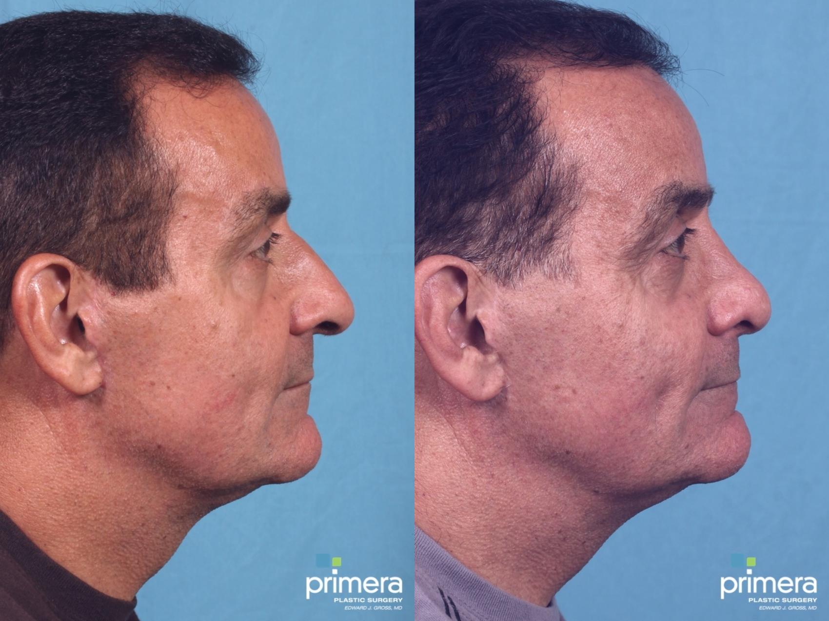 Before & After Rhinoplasty Case 39 view-1 View in Orlando, Florida