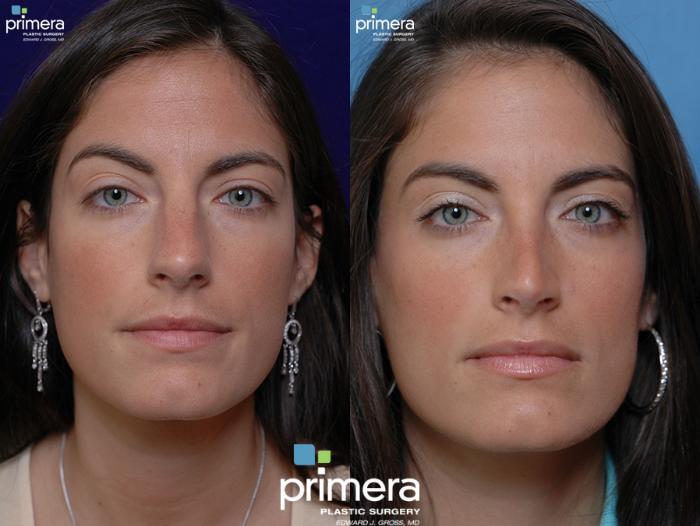 Before & After Rhinoplasty Case 40 view-1 View in Orlando, Florida