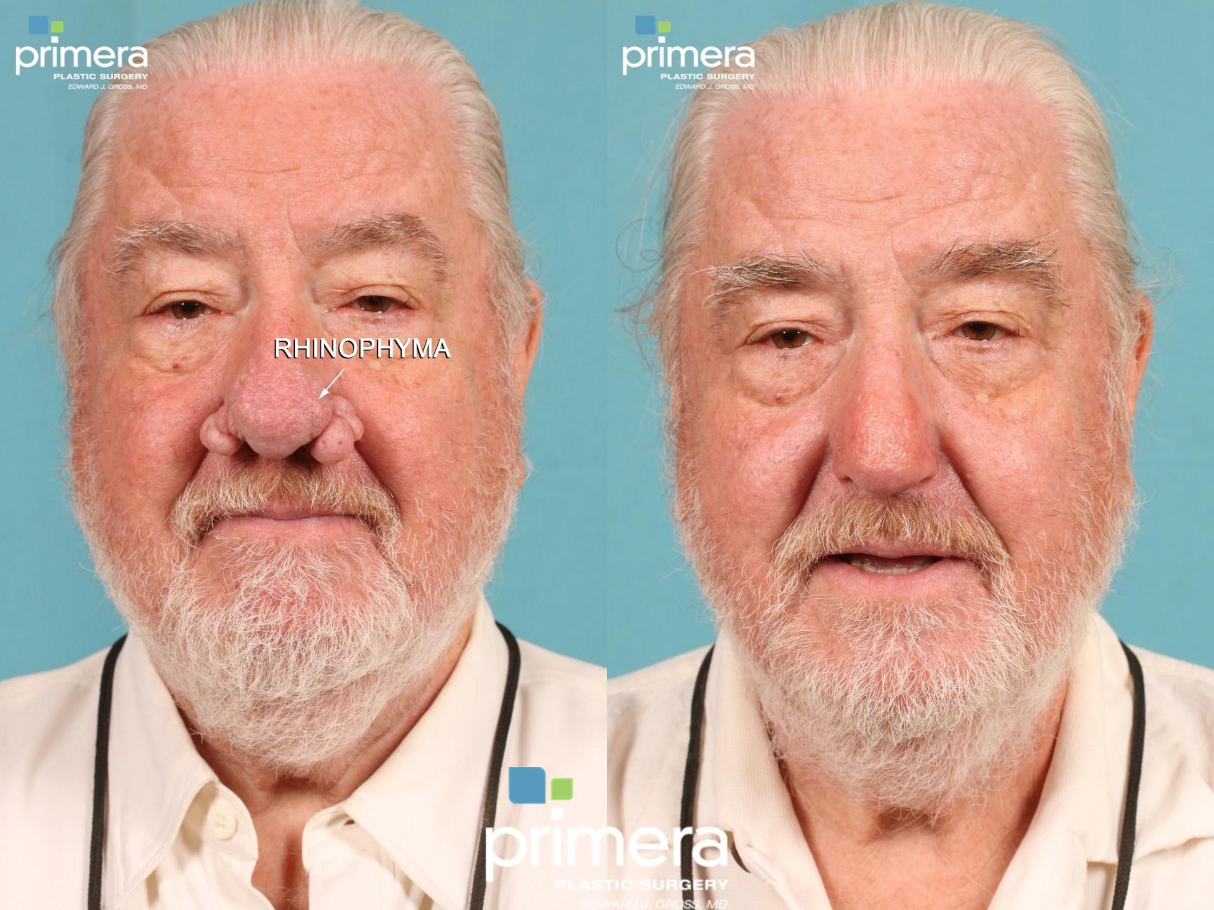 Before & After Surgery for Men Case 411 view-1 View in Orlando, Florida