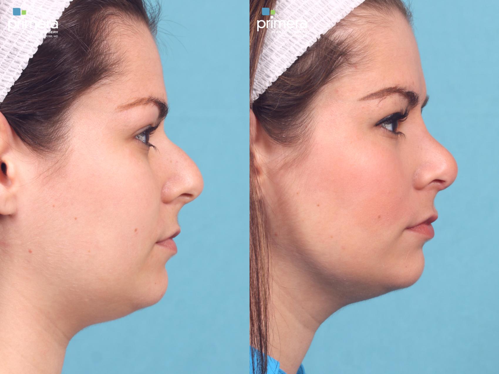 Rhinoplasty Before And After Pictures Case 413 Orlando Florida