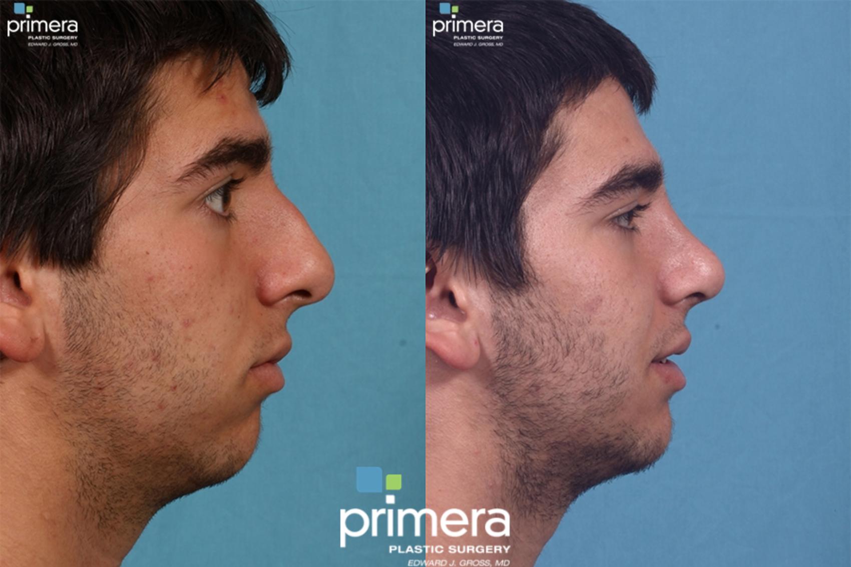 Before & After Rhinoplasty Case 42 view-1 View in Orlando, Florida