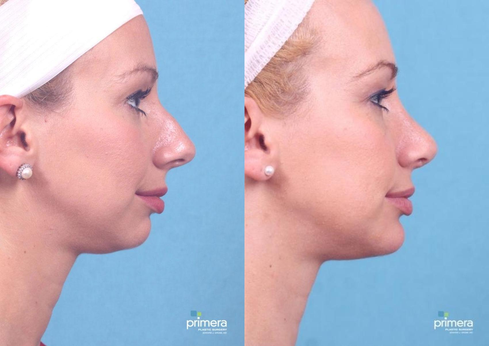 Before & After Rhinoplasty Case 428 view-1 View in Orlando, Florida