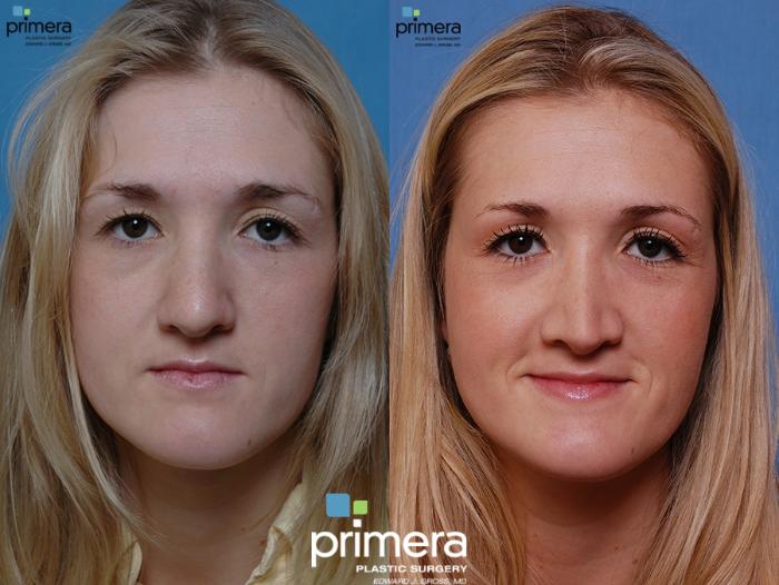 Before & After Rhinoplasty Case 43 view-1 View in Orlando, Florida