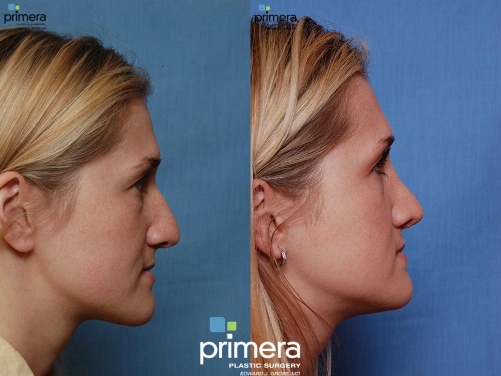 Before & After Rhinoplasty Case 43 view-2 View in Orlando, Florida