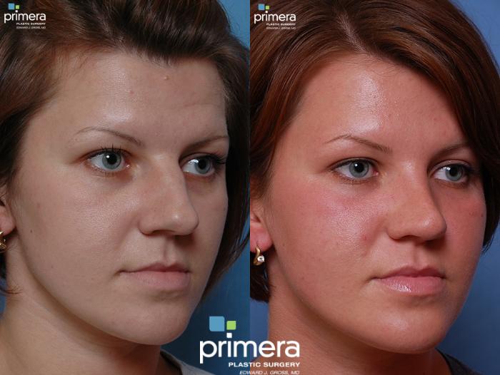 Before & After Rhinoplasty Case 45 view-1 View in Orlando, Florida