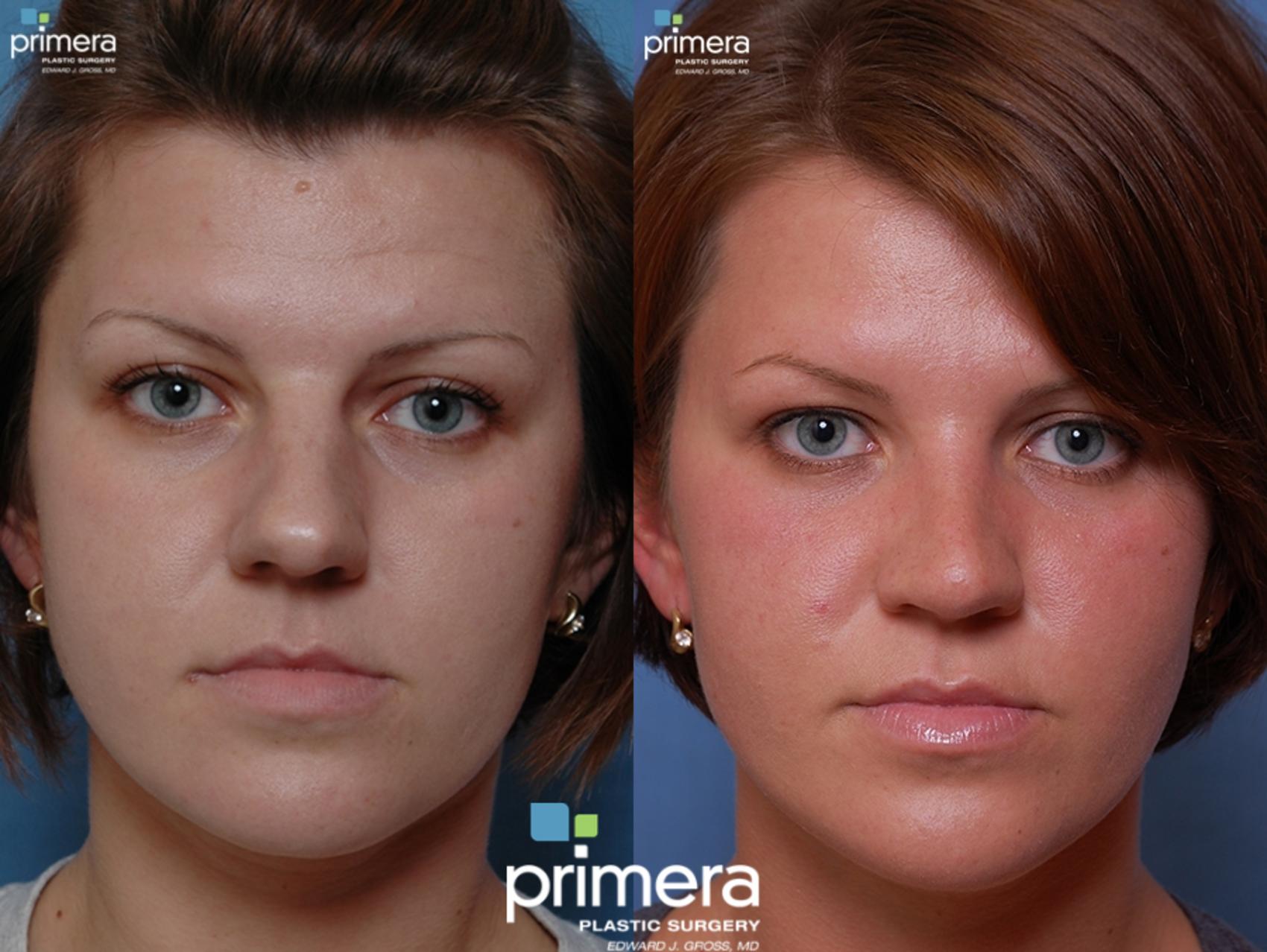 Before & After Rhinoplasty Case 45 view-2 View in Orlando, Florida