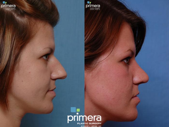 Before & After Rhinoplasty Case 45 view-3 View in Orlando, Florida