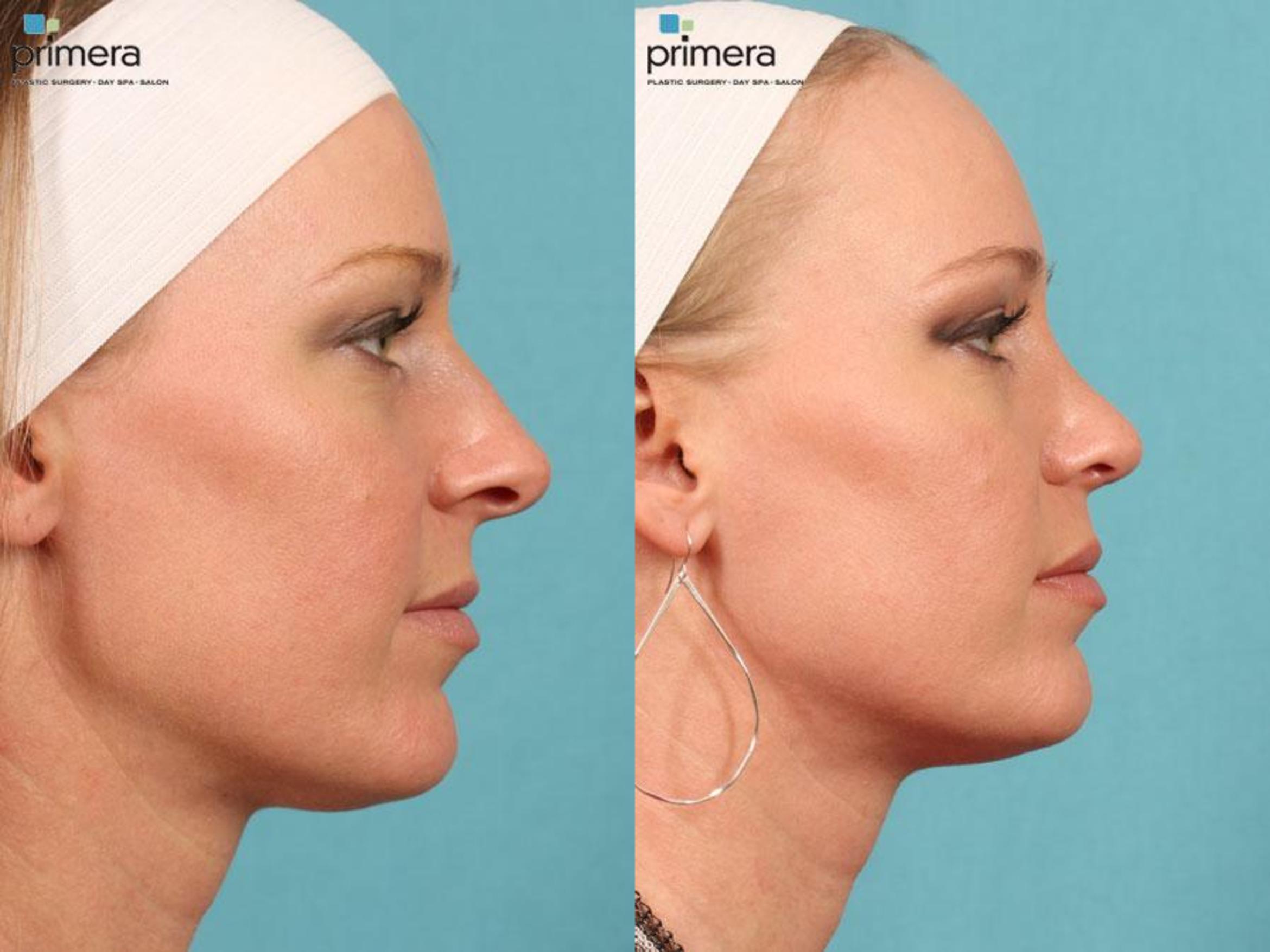 Rhinoplasty Before & After Photo | Orlando, Florida | Primera Plastic Surgery