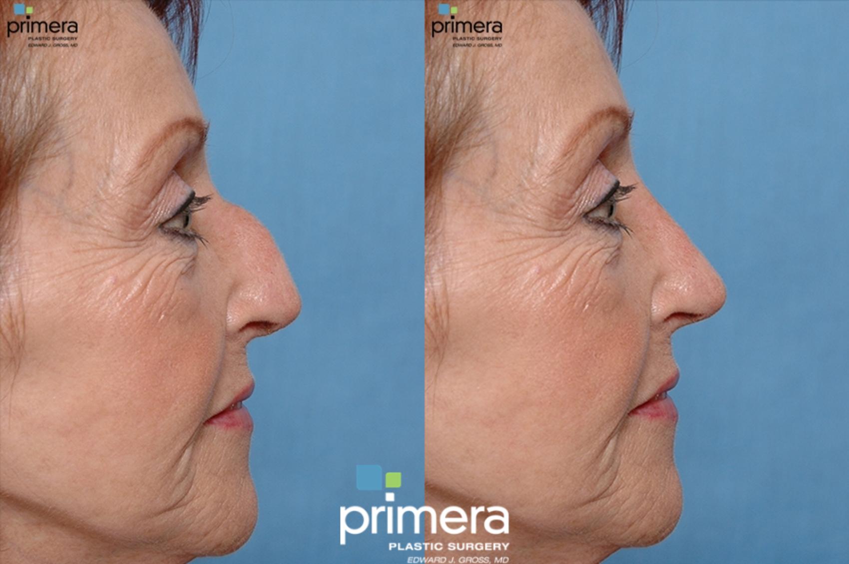 Before & After Rhinoplasty Case 51 view-1 View in Orlando, Florida