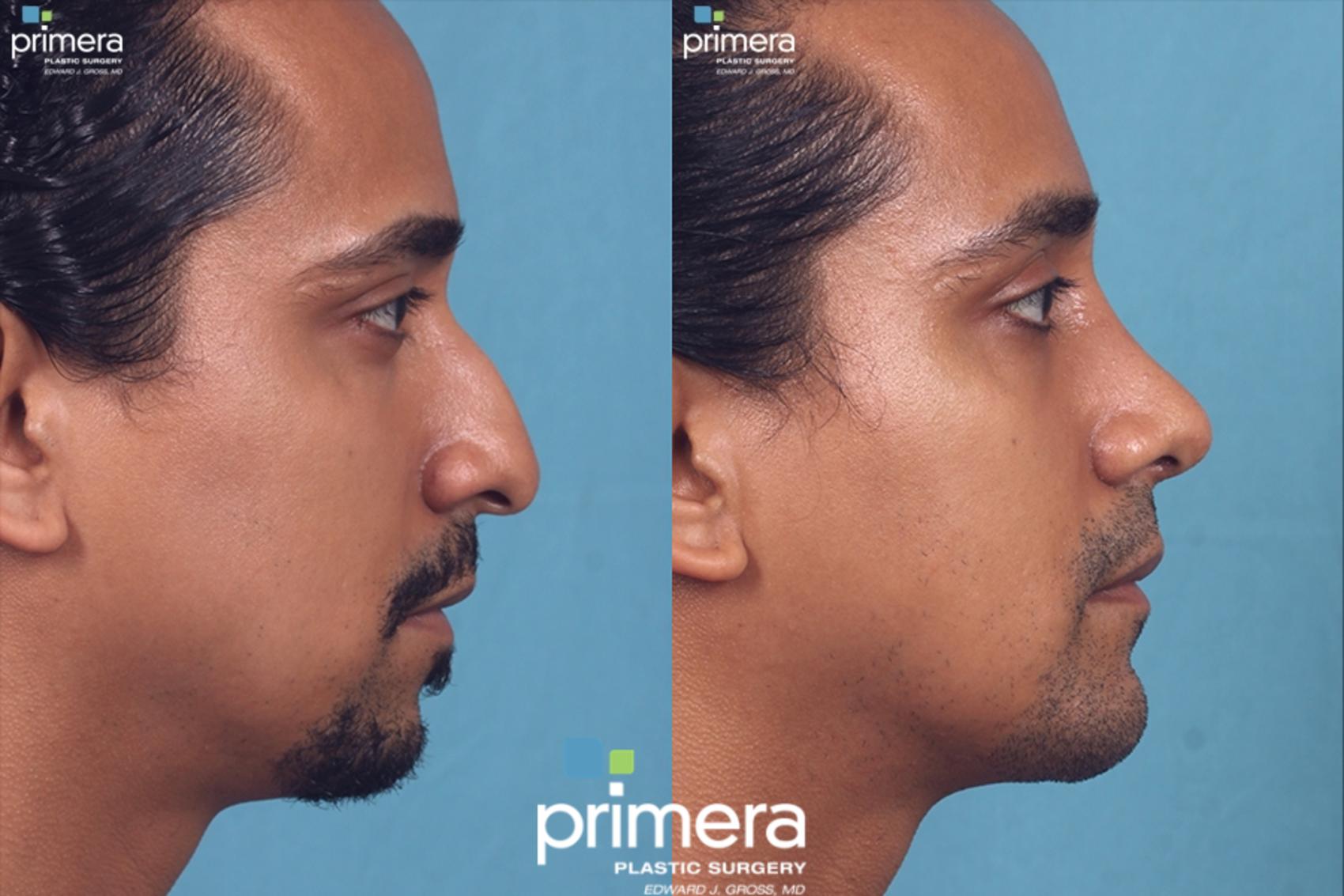 Before & After Rhinoplasty Case 55 view-1 View in Orlando, Florida