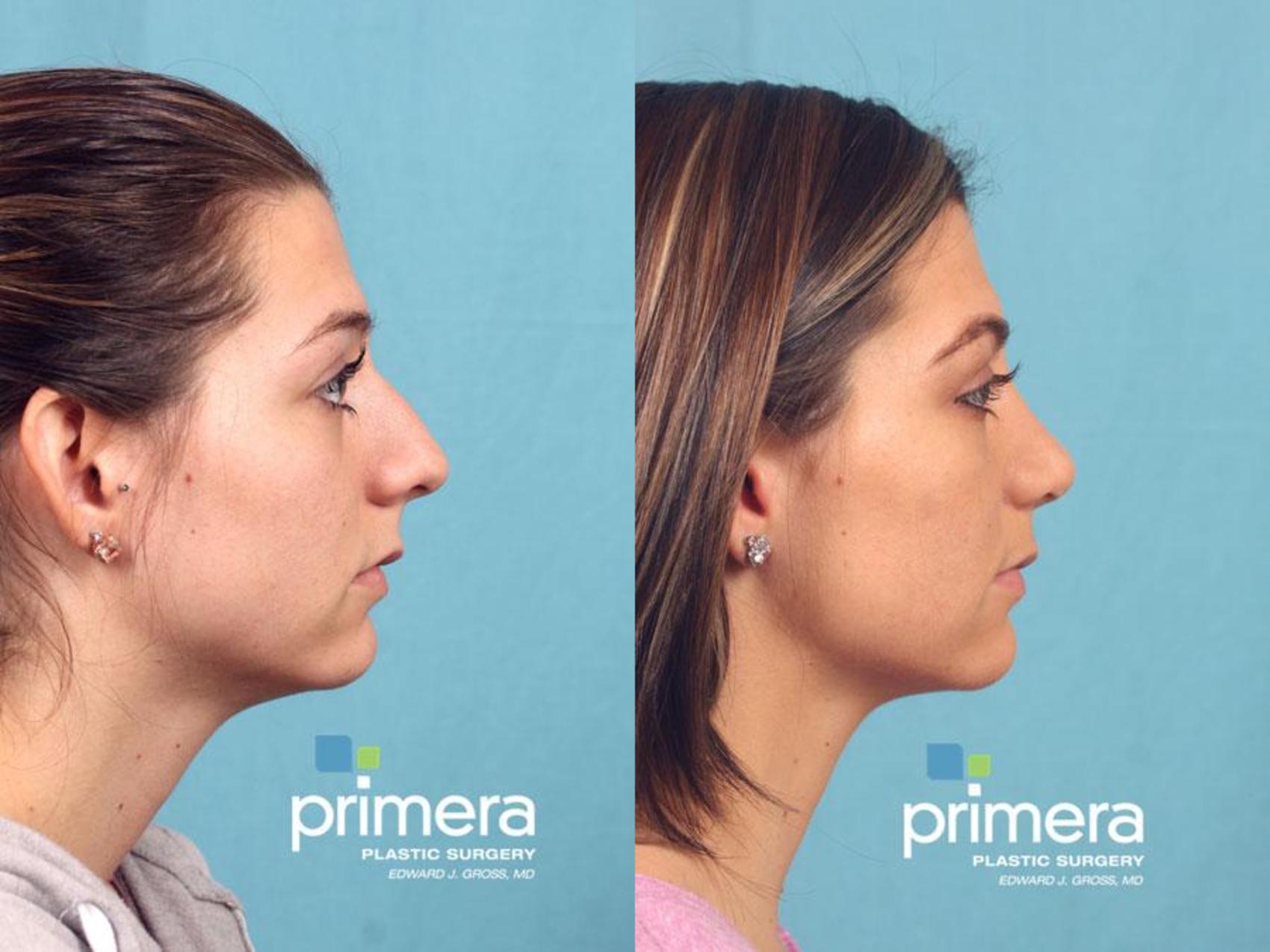 She consulted with Dr. Gross in our Orlando/ Lake Mary office to remove a l...