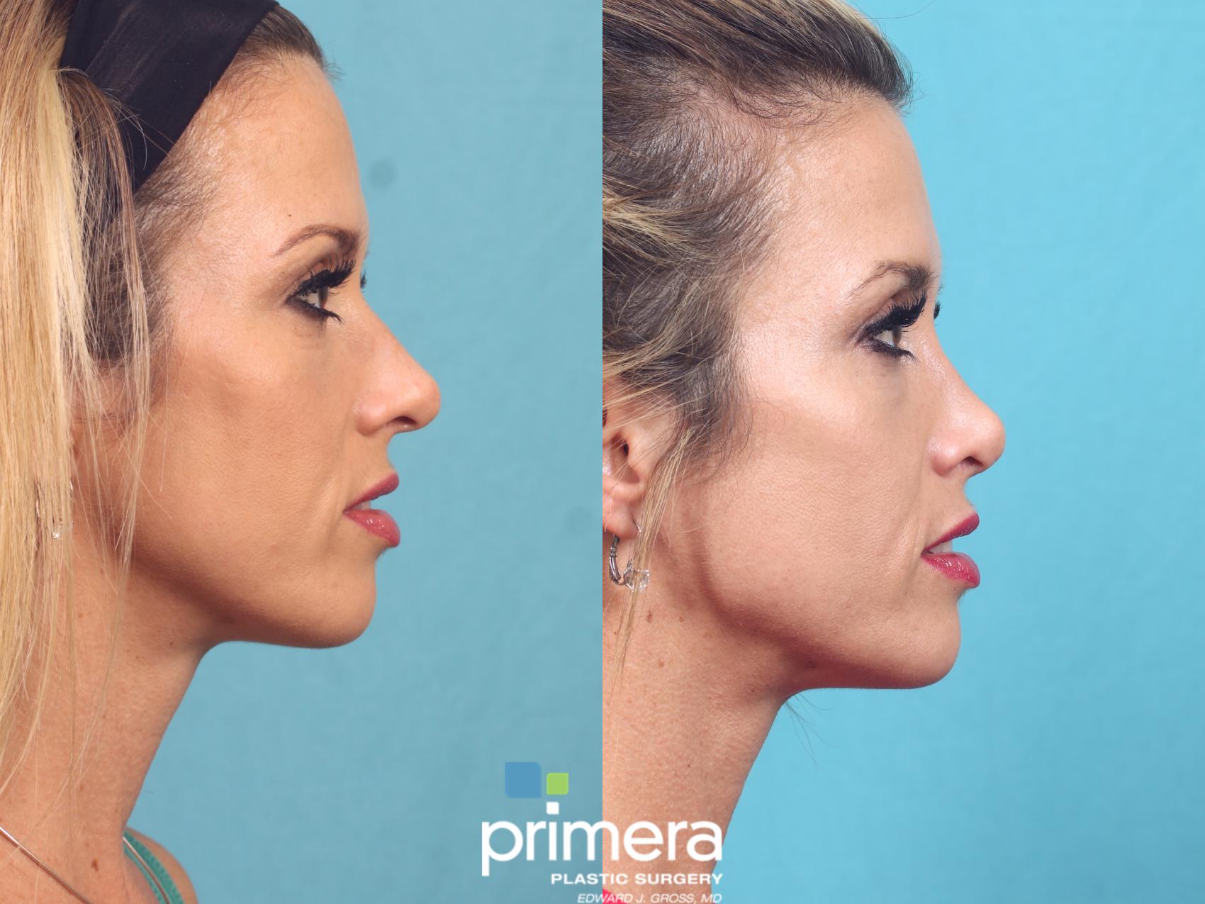 Rhinoplasty Orlando