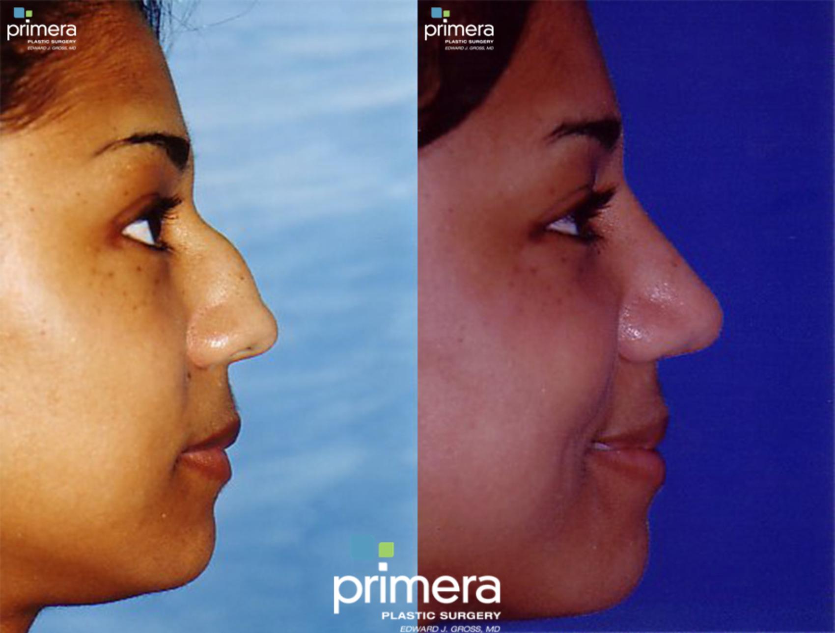 Rhinoplasty for African American Women in Orlando